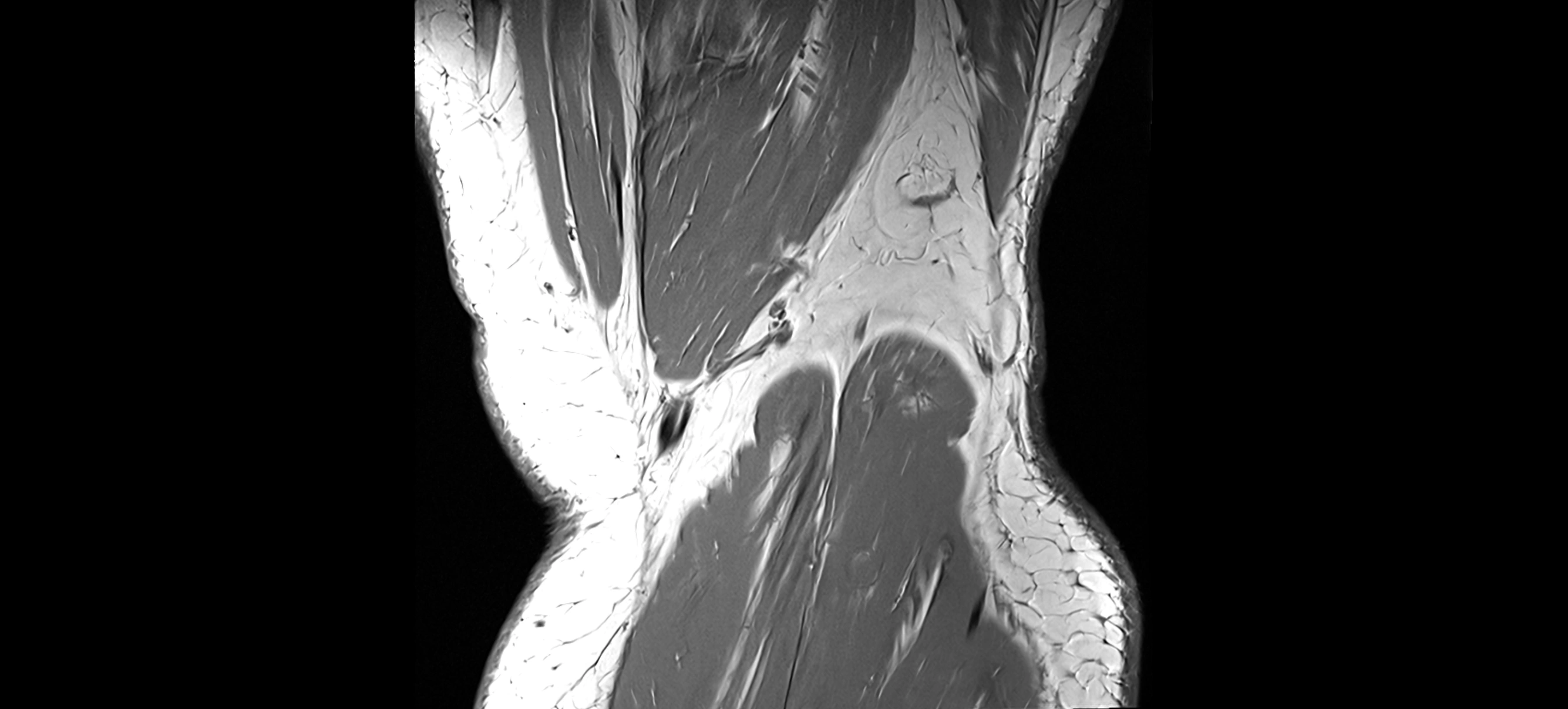 MRI coronal  ligaments cross sectional anatomy 3T  radiology  image-img-04001-00040.webp
